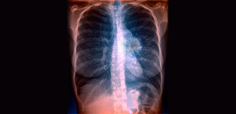 Bild, das Lungenkrebs zeigt