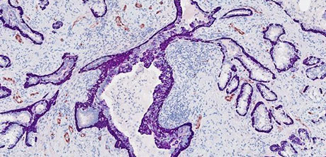 Ein menschliches Prostata-Adenokarzinom, gefärbt mit ERG-Immunhistochemie (braun) und CK5-Immunhistochemie (lila). 